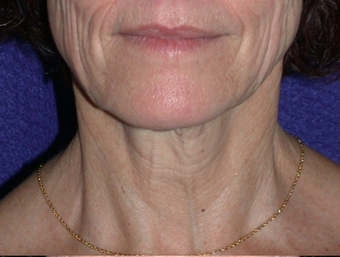 Necklift