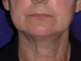 Necklift