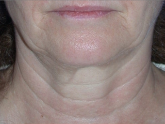 Necklift