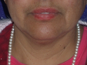 Necklift