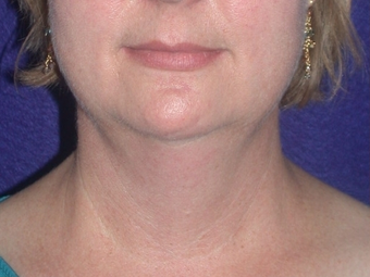 Necklift
