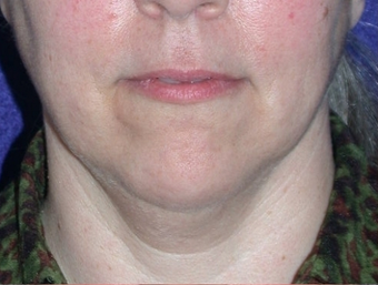 Necklift