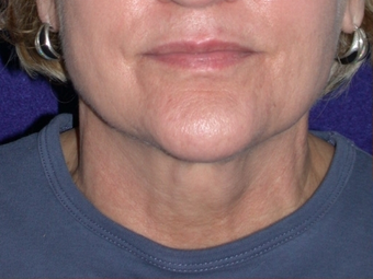 Necklift