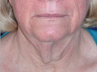 Necklift