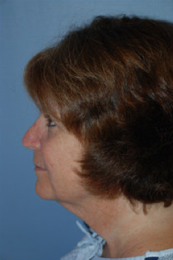 Neck Lift
