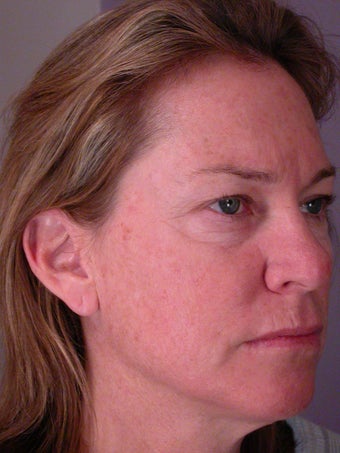 Neck Lift