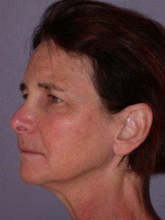 Neck lift