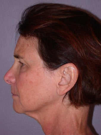 Neck lift