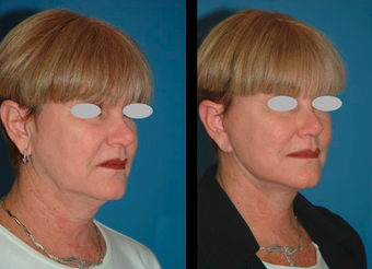 Neck lift and Mini-facelift