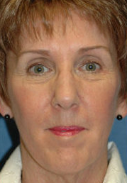 Neck Lift Surgery