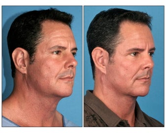 Neck Lift