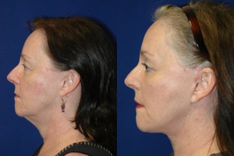 Neck lift