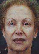 Necklift