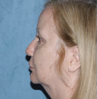 Neck Lift