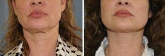 52 year old. Two month status post neck lift.