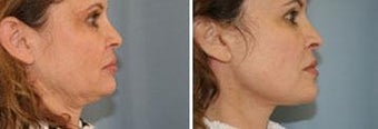 52 year old. Two month status post neck lift.
