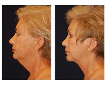 Neck Lift