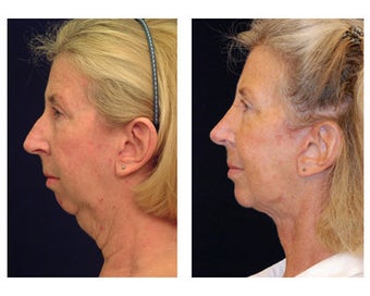 Neck Lift