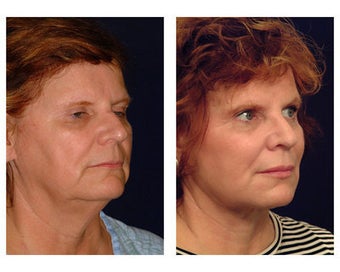 Neck Lift