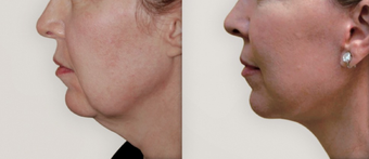 Neck Lift