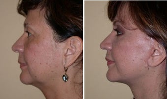 Necklift 