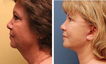 Necklift