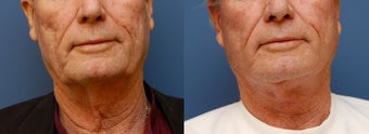 Necklift
