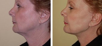 Necklift
