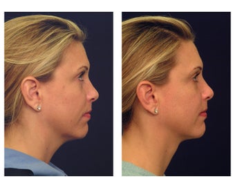 Neck Lift & Lower Facial Rejuvenation