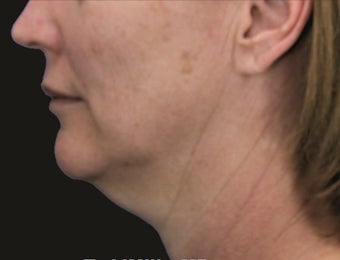 Neck Lift and Laser-Assised Lipocontouring