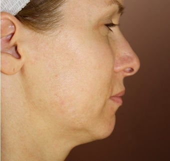 Neck Lift and Upper Eyelid Blepharoplasty