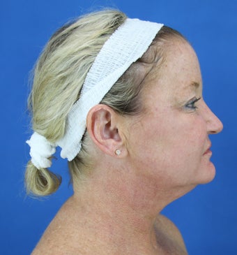 neck lift