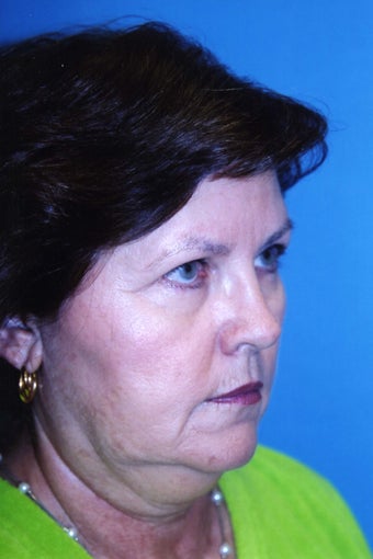 Weekend Necklift 