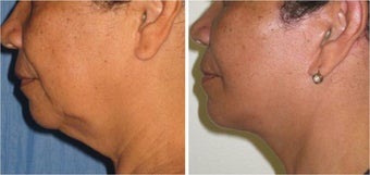 Neck Lift and Liposuction