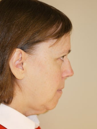 Neck Liposuction