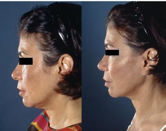 Neck Lift