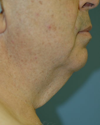 Neck Lift