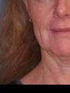 Facial Refinement: Necklift