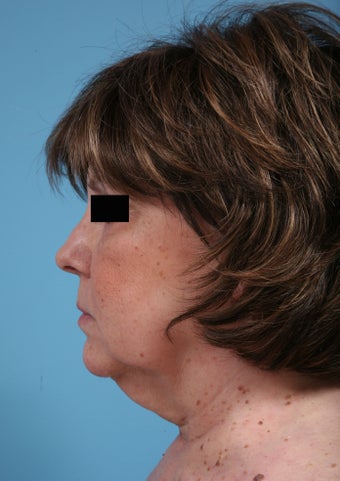 Neck lift