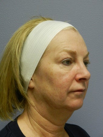 Neck Lift 