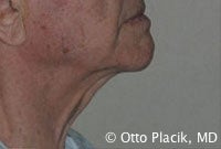 Cervicoplasty