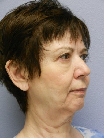 Lower Face Neck Lift 