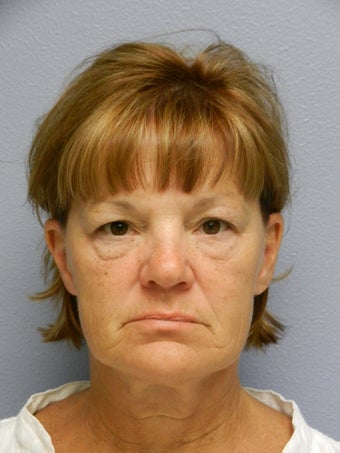Lower Face with Neck Lift