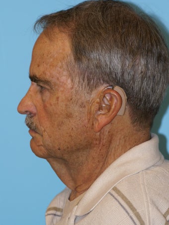 Necklift