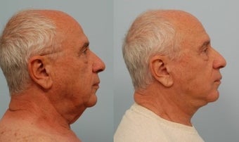 Neck Lift 