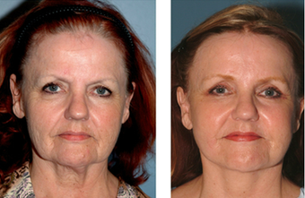 Neck Lift