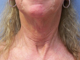 Neck lift