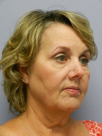 Neck Lift 