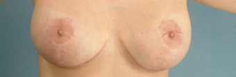 Areola Reduction and Breast Augmentation