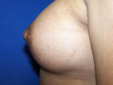 Nipple Repair